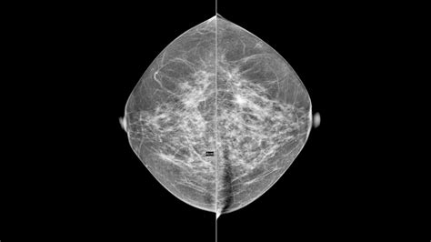 Understanding Your Mammogram Results .
